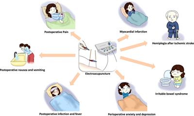 Clinical application of electroacupuncture in enhanced recovery after surgery